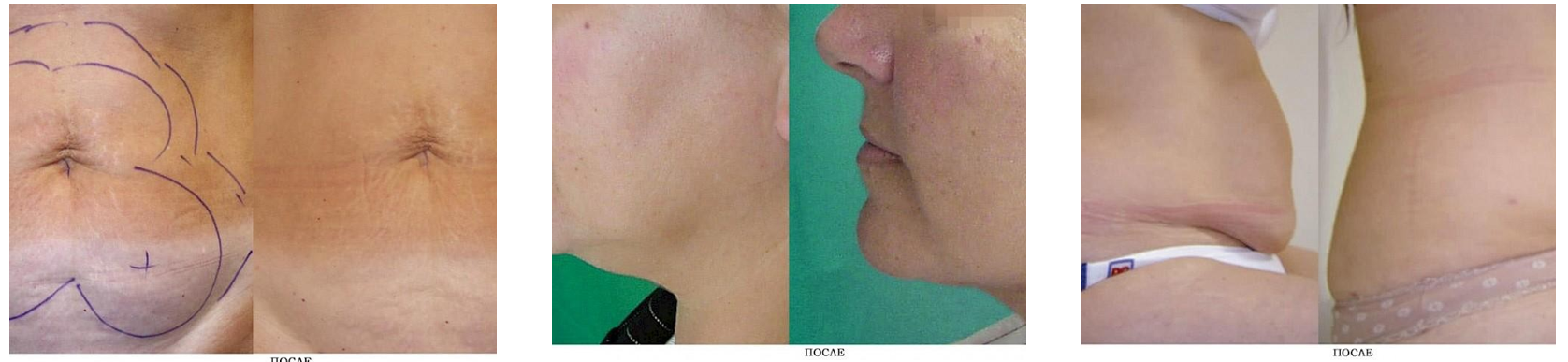 Lipo